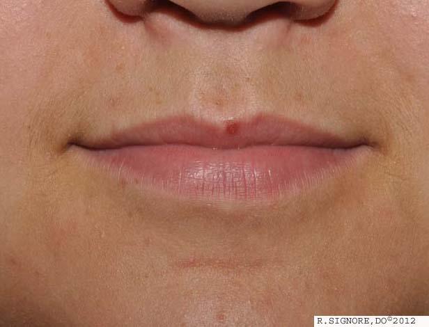 This is the same patient , as seen in the above photo, twelve weeks later:  you can see her MOLLUSCUM CONTAGIOSUM AROUND THE MOUTH are ALL CLEAR, after taking her constitutional homeopathic remedy.