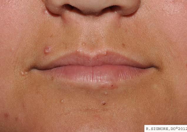 This young patient came to Dr. Signore's dermatology office because she had an eruption AROUND THE MOUTH for the past one year.  These were not acne pimples - Dr. Signore diagnosed a viral imfection known as MOLLUSCUM CONTAGIOSUM.  The patient and her mother chose homeopathic medicine.  Over the next three months, Dr. Signore prescribed three different homeopathic medicines.  When she began the third remedy, which was her CONSTITUTIONAL HOMEOPATHIC REMEDY, her molluscum began to fade away very nicely (see photo BELOW).
