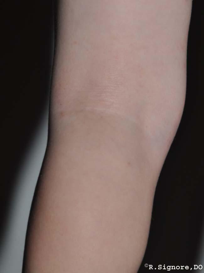 The above photo shows the same infant with ATOPIC ECZEMA after 20 weeks of homeopathic medicine, which he took by mouth. As you can see, his ECZEMA on his left leg is ALL CLEAR. Also, most of his eczema on his upper body is clear as well. The infant's mood has also improved as well.