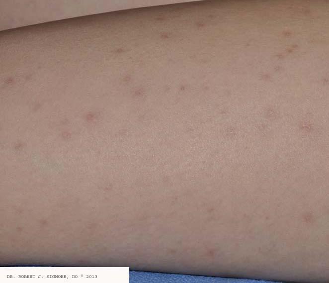 The above photo shows Dr. Signore's same patient, eight weeks after beginning her homeopathic remedy.  Her MOLLUSCUM CONTAGIOSUM are ALL CLEAR. 