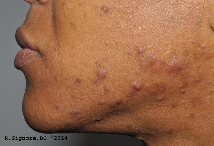 This is a photo of a patient who came to Dr. Signore's dermatology office who had facial pimples (ACNE VULGARIS) for ten years.  But, for the last two years, her acne had worsened with increased emotional stress.