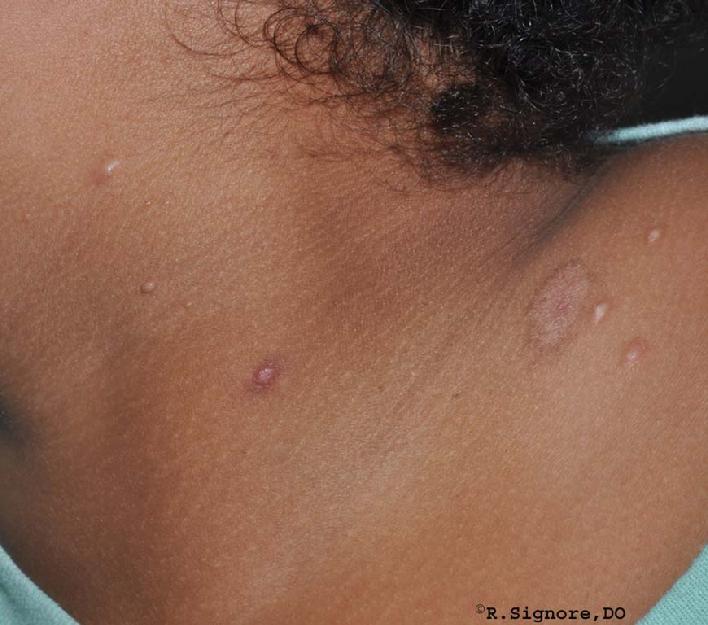 This young child had MOLLUSCUM CONTAGIOSUM, a viral skin infection, on her neck and shoulder for the past four months.  Her parents had applied a prescription cream, imiquimod cream, but it irritated her skin and had not helped that much.  She was fearful of painful surgical procedures, so she and her parents decided to try CLASSICAL HOMEOPATHIC MEDICINE.  Over the next four months, Dr. Signore prescribed two separate homeopathic remedies, taken by mouth, which matched her physical and emotional traits the closest.