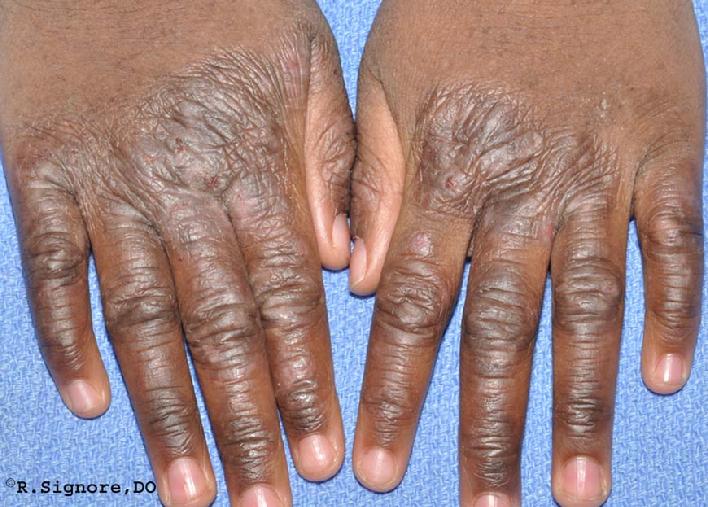 This young child was seen in Dr. Signore's dermatology office for widespread ATOPIC ECZEMA.  Her eczema itched so badly that it woke her up every night with terrible scratching episodes.  Her skin began to itch whenever she was in contact with water (eg. bathing and swimming).  Her skin also began itching when she was covered with too many sheets or blankets at bedtime.  She was a very warm child and was never chilly.  Her family wanted to try CLASSICAL HOMEOPATHIC MEDICINE for her eczema, because they wanted to treat it without having to use steroids.  Dr. Signore asked numerous questions about the child.  Based on these questions, he selected her INDIVIDUALIZED HOMEOPATHIC CONSTITUTIONAL REMEDY.
