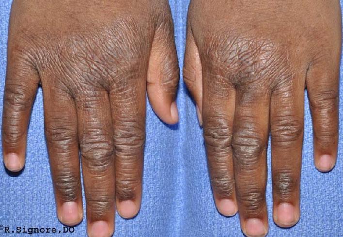 This is the SAME YOUNG CHILD after 13 weeks of taking her CONSTITUTIONAL HOMEOPATHIC REMEDY by mouth three times per week. As you can see, her ATOPIC ECZEMA is about 60% IMPROVED. Her skin is much softer and less thickened. She is much less itchy & she can sleep through the entire night! Since beginning her classical homeopathic medicine, her constipation has improved greatly and she is also less thirsty. IT IS COMMON FOR OTHER MEDICAL ISSUES TO IMPROVE when dermatology patients are treated with classical homeopathic medicine for their skin issues. his patient's mother only needed to apply a low potency steroid ONLY ONCE in the last 13 weeks since beginning her homeopathic remedy. When the correct homeopathic remedy is found, the use of topical steroids CAN OFTEN BE GREATLY REDUCED.
