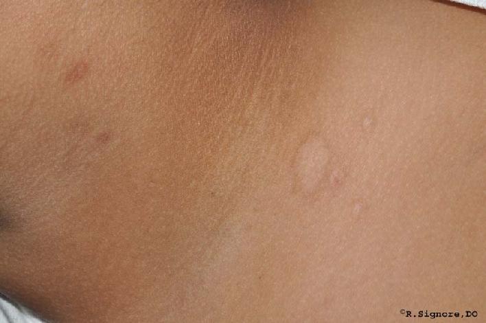 This is the same child after taking her individualized homeopathic remedies by mouth for approximately four months.  You can see that her MOLLUSCUM CONTAGIOSUM are COMPLETELY GONE.  This child was very happy that she did not have to undergo a painful surgical procedure to remove her molluscum contagiosum.  She has stopped taking the homeopathic remedy by mouth, but she will continue applying 14% glycolic acid lotion to help fade her postinflammatory hyperpigmentation.  