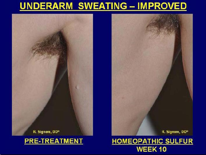 Photo of gentleman seen in Dr. Signore's Tinley Park, Illinois dermatology office with idiopathic localized axillary hyperhidrosis. Second photo shows this same man after his severely dripping perspiration has stopped following prescription of his individualized homeopathic natural medicine, which happened to be sulphur.