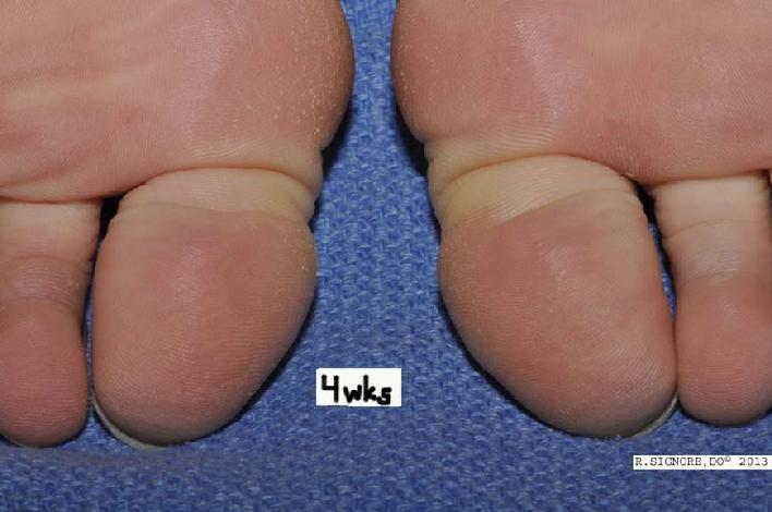 Photo showing all plantar warts have resolved at week 4 after starting homeopathic medicine from Dr. Signore's dermatology office.  