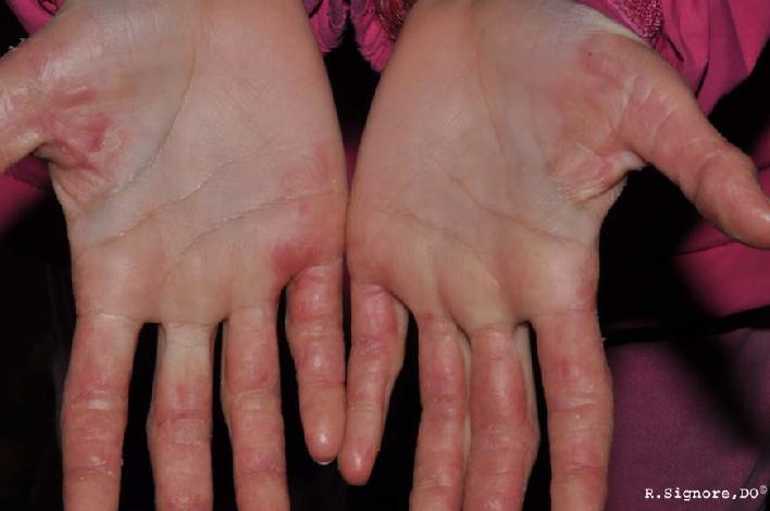 This child was brought to Dr. Signore's Tinley Park dermatology office for dry and red peeling skin on the hands, fingers, and toes.  She developed this rash before kindergarten.  She was previously treated by two dermatologists and one pediatric dermatologist with topical steroids, topical Retin-A (tretinoin), and 40 outpatient ultraviolet light phototherapy sessions WITHOUT SUCCESS.  She was brought to Dr. Signore for classical homeopathic medicine for her skin condition.  She underwent a two hour homeopathic consultation visit & Dr. Signore asked the child and parent many questions about her rash and also about her health.  This patient appeared to have ACRAL PEELING SKIN SYNDROME.  Dr. Signore treated her with HOMEOPATHIC SILICA twice a day by mouth.  Dr. Signore chose this remedy because the child's personality and physical characteristics most closely fit those of this individual homeopathic remedy.