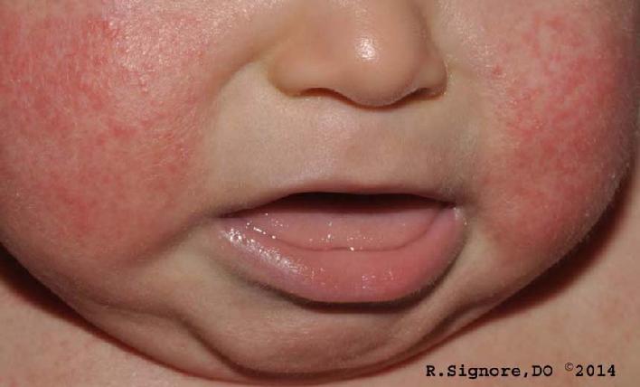 This 6 month old infant was diagnosed by Dr. Signore with ATOPIC ECZEMA (atopic dermatitis). Atopic eczema is an itchy skin disease which is commonly seen in infants and children. Atopic eczema is seen in about 3 percent of young children. Atopic eczema often BEGINS AT THREE MONTHS OF AGE, but it can occur sooner. There is NO CURE for eczema, but dermatologists have helpful treatments than can keep eczema under control. As children with ATOPIC ECZEMA get older, they often develop ASTHMA or ALLERGIC RHINITIS (Hayfever, Seasonal Allergies). Children with atopic eczema often have other family members with eczema, asthma, or allergies.