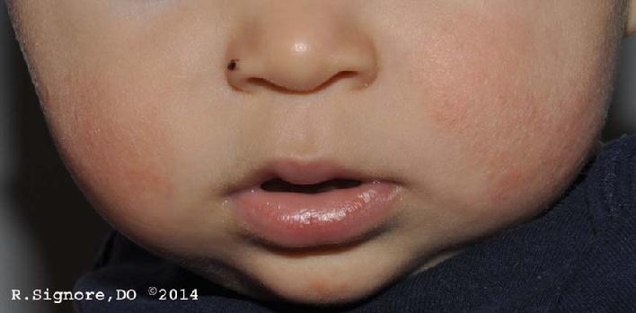 This is the same patient, as seen above, FOUR MONTHS LATER. Dr. Signore started a new homeopathic remedy, which is derived from natural sea salt. After Dr. Signore was able to find his specific CONSTITUTIONAL HOMEOPATHIC REMEDY, his ATOPIC ECZEMA IMPROVED noticeably. You can see that his facial eczema is much better. His arms also improved (SEE PHOTO TO RIGHT), and eczema on the legs and neck cleared completely. The EARLIER children begin homeopathic therapy for eczema, the BETTER and more readily they respond. (NOTE: NO STEROIDS OR ANTIBIOTICS WERE PRESCRIBED.)