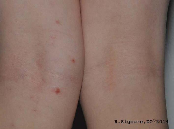 Photo of Dr. Signore's dermatology patient showing his molluscum infection is much better with homeopathic treatment.