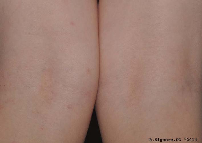 This photo shows the same young boy, as seen above.  His MOLLUSCUM CONTAGIOUSUM are ALL CLEAR.   Over a period of 7 months, Dr. Signore treated him with individually selected natural homeopathic remedies.  His MOLLUSCUM CONTAGIOSUM infection rapidly began to clear once Dr. Signore began a mineral remedy, which is derived from natural sea salt.  