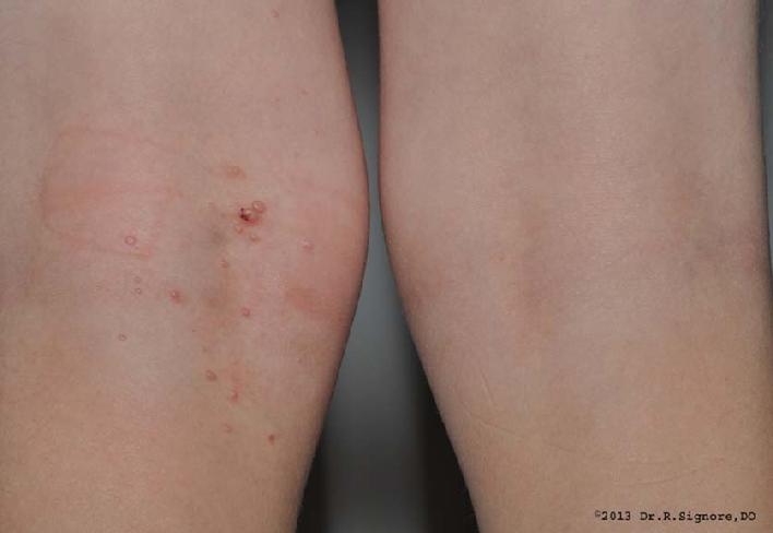 This young boy was diagnosed by Dr. Signore with MOLLUSCUM CONTAGIOSUM, a common viral skin infection.  Molluscum contagiosum can be spread from child to child through skin to skin contact.  This infection was present for six months and it had also spread to the ankle and back.  He and his parent chose to begin homeopathic medicines, as they wanted to avoid painful surgical or freezing therapies.