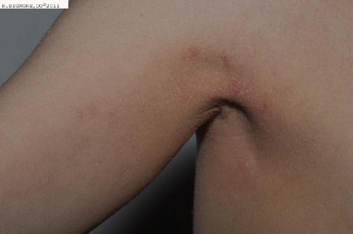 This photo shows the same young boy FOUR WEEKS LATER after Dr. Signore prescribed his CONSTITUTIONAL HOMEOPATHIC REMEDY, derived from a calcium-containing mineral.  You can see that his MOLLUSCUM CONTAGIOSUM are ALL CLEAR.  Interestingly, his ATOPIC ECZEMA began to clear up and his father observed that his skin was MUCH LESS ITCHY.  Therefore, we continued his homeopathic remedy for four more weeks, and then we stopped his medicine.  Sometimes, OTHER MEDICAL PROBLEMS MAY IMPROVE when a person with skin diseases is treated with CLASSICAL HOMEOPATHIC MEDICINE.