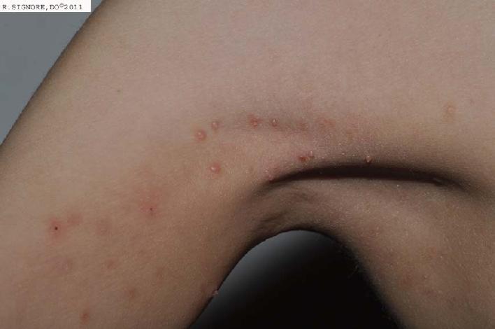 The child in this photo was diagnosed with MOLLUSCUM CONTAGIOSUM by Dr. Signore.  This viral infection was present for over three months.  In addition, he also had atopic eczema, an itchy dry skin condition.  His mother chose classical homeopathic medicine.  Dr. Signore asked him a lot of questions to help determine what his homeopathic constitutional type was.  Based on the patient's individual physical, emotional, and emotional characteristics, Dr. Signore prescribed his CONSTITUTIONAL HOMEOPATHIC REMEDY , which in his case was derived from a calcium-containing mineral.  Classical homeopathic medicine takes into consideration each patient's UNIQUE TRAITS in order to find the person's correct remedy.  So, two patients with MOLLUSCUM CONTAGIOSUM might each require a DIFFERENT remedy even though they have the SAME skin disease.