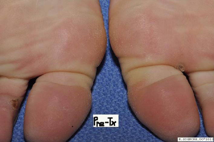 Dr. Signore's patient with plantar warts prior to homeopathic treatment.