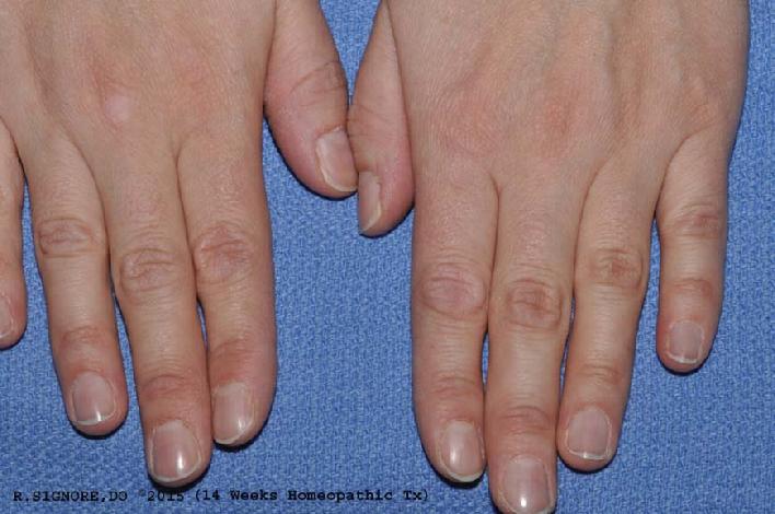 The above photo shows this same VITILIGO patient after taking her HOMEOPATHIC medicine every night for several months. You can see that her white skin patches have greatly improved and her VITILIGO is MUCH LESS VISIBLE. (Note: no topical creams or ointments were used.) Additionally, even her husband noticed that her mood was much better. Also, she was much less stress-out over little things that formerly would have upset her. Since starting her homeopathic medicine, this patient noticed her headaches were much less severe and her loose stools had completely cleared up. It is common for seemingly unrelated medical issues to improve during treatment with homeopathic medicine.