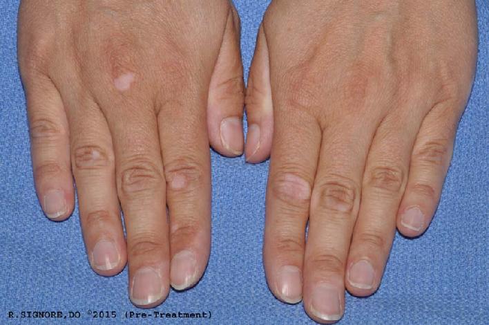 This very nice patient came to Dr. Signore's dermatology office in Tinley Park because she noticed WHITE PATCHES on her hands and elbow. (See photo above.) These white spots appeared shortly after she experienced a humiliating incident where she was rudely treated. Dr. Signore diagnosed this patient as having VITILIGO. Vitiligo is a very difficult to treat autoimmune skin disease characterized by loss of skin pigment. Dr. Signore treated her with a homeopathic natural medicine, which was derived from a flower, because it precisely fit her symptoms of suppressed anger after humiliation. She took the homeopathic medicine by mouth each night for about three months.This very nice patient came to Dr. Signore's dermatology office in Tinley Park because she noticed WHITE PATCHES on her hands and elbow. (See photo above.) These white spots appeared shortly after she experienced a humiliating incident where she was rudely treated. Dr. Signore diagnosed this patient as having VITILIGO. Vitiligo is a very difficult to treat autoimmune skin disease characterized by loss of skin pigment. Dr. Signore treated her with a homeopathic natural medicine, which was derived from a flower, because it precisely fit her symptoms of suppressed anger after humiliation. She took the homeopathic medicine by mouth each night for about three months.