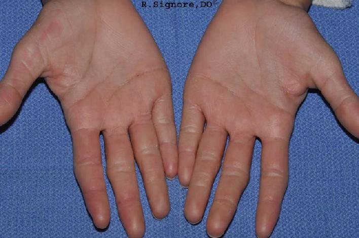 The photo below shows the same child 19 weeks after beginning HOMEOPATHIC CONSTITUTIONAL MEDICAL TREATMENT for her ACRAL PEELING SKIN SYNDROME.  As you can observe, she has MUCH LESS REDNESS AND PEELING OF HER FINGERS AND PALMS.  (The only other treatment prescribed was over-the-counter AquaGlycolic Hand and Body Lotion which she applied only to the hands.  (NOTE:  This patient's toes cleared up completely, even though she did not apply the AquaGlycolic  lotion to the toes.  This is highly suggestive that the homeopathic SILICA treatment contributed to this patients' healing of her hands, fingers, and toes.)   The only adverse effect the patient experienced was drowsiness after taking homeopathic SILICA in the morning.  The patient then began taking her homeopathic remedy at night and she had no further daytime drowsiness.         Interestingly, while this child was being treated with HOMEOPATHIC MEDICINE for her skin condition, her constipation, excessive sweating, and foot odor also IMPROVED.  Her difficulty focusing and paying attention  while doing homework also IMPROVED GREATLY during her homeopathic medical treatment.  Sometimes other seemingly unrelated medical issues may improve during homeopathic treatment of skin diseases.       Thus, homeopathic constitutional treatment  CAN be HELPFUL for CHILDREN WITH SKIN DISEASES.  The EARLIER in life a child's skin diseases are treated with homeopathic medicine, the MORE READILY they seem to IMPROVE.