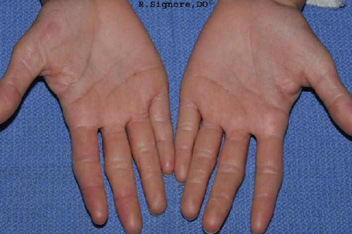 The photo below shows the same child 19 weeks after beginning HOMEOPATHIC CONSTITUTIONAL MEDICAL TREATMENT for her ACRAL PEELING SKIN SYNDROME. As you can observe, she has MUCH LESS REDNESS AND PEELING OF HER FINGERS AND PALMS. (The only other treatment prescribed was over-the-counter AquaGlycolic Hand and Body Lotion which she applied only to the hands. (NOTE: This patient's toes cleared up completely, even though she did not apply the AquaGlycolic lotion to the toes. This is highly suggestive that the homeopathic SILICA treatment contributed to this patients' healing of her hands, fingers, and toes.) The only adverse effect the patient experienced was drowsiness after taking homeopathic SILICA in the morning. The patient then began taking her homeopathic remedy at night and she had no further daytime drowsiness. Interestingly, while this child was being treated with HOMEOPATHIC MEDICINE for her skin condition, her constipation, excessive sweating, and foot odor also IMPROVED. Her difficulty focusing and paying attention while doing homework also IMPROVED GREATLY during her homeopathic medical treatment. Sometimes other seemingly unrelated medical issues may improve during homeopathic treatment of skin diseases. Thus, homeopathic constitutional treatment CAN be HELPFUL for CHILDREN WITH SKIN DISEASES. The EARLIER in life a child's skin diseases are treated with homeopathic medicine, the MORE READILY they seem to IMPROVE.