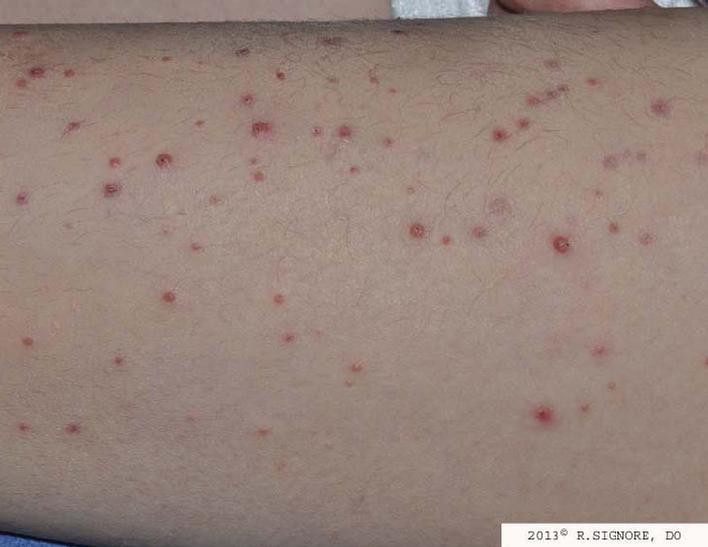 This young person was treated at Dr. Signore's Tinley Park dermatology office because she had numerous MOLLUSCUM CONTAGIOSUM on the lateral thigh for two months.  After a detailed interview, Dr. Signore selected her constitutional homeopathic medicine, which was derived from the Pasque Flower.