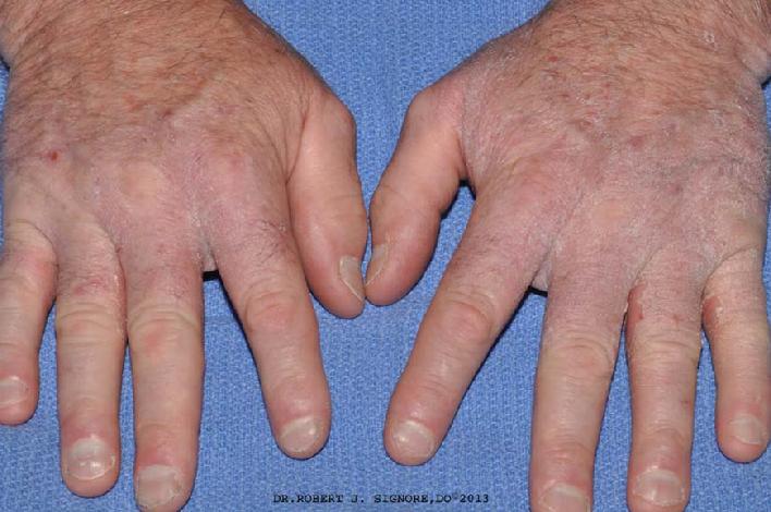 This is a photo of a man with HAND ECZEMA before being treated by Dr. Signore with homeopathic medicine, a form of alternative medicine.