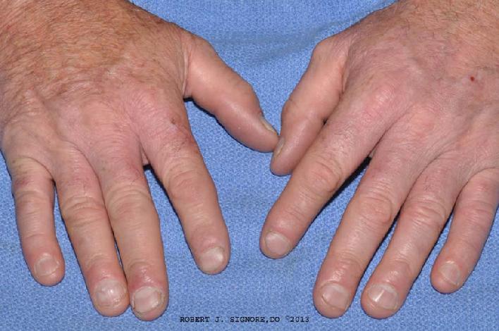 Photo showing HAND ECZEMA is all clear with homeopathic medicine.  NOTE:  It has been over five years since this patient was treated with HOMEOPATHIC MEDICINE for his HAND ECZEMA.  At his 5 year follow-up appointment, his hand eczema is STILL ALL CLEAR!  This demonstrates that the results of homeopathic treatment can be quite durable.  