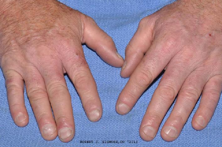 Photo showing HAND ECZEMA is all clear with homeopathic medicine. NOTE: It has been over five years since this patient was treated with HOMEOPATHIC MEDICINE for his HAND ECZEMA. At his 5 year follow-up appointment, his hand eczema is STILL ALL CLEAR! This demonstrates that the results of homeopathic treatment can be quite durable.