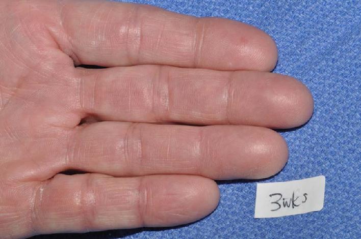 This photo shows the same gentleman's hand 3 weeks after beginning his individualized homeopathic constitutional therapy.  You can see that his hand eczema is completely clear.  He now can play the guitar without annoying cracks in the skin.  He also used Aveeno Moisturizing Cream at night on his hands and a prescription cream (Exelderm Cream) twice a day for his athlete's foot fungus infection.   