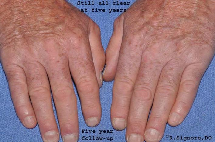 THIS IS THE SAME MAN, FIVE YEARS LATER, WITH HAND ECZEMA STILL ALL CLEAR SINCE STOPPING HIS HOMEOPATHIC MEDICINE FIVE YEARS AGO.  THIS SHOWS THAT THE RESULTS OF HOMEOPATHIC MEDICINE CAN BE DURABLE & LONG LASTING.