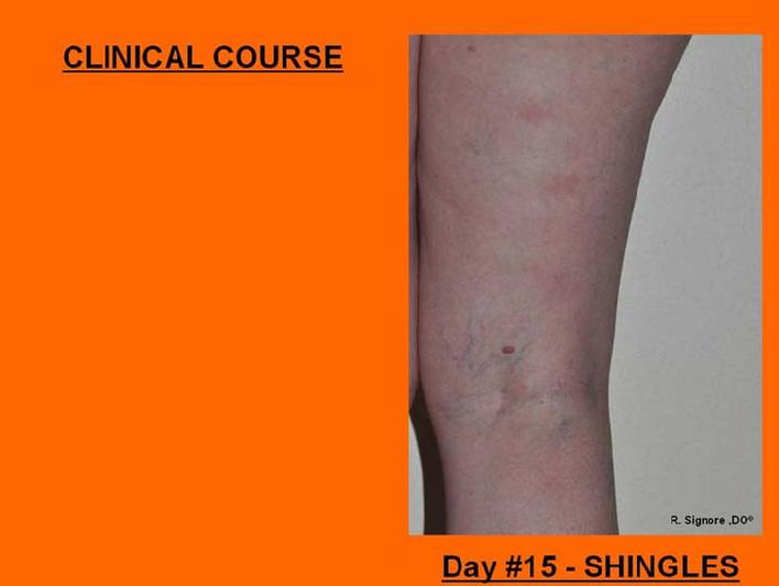 Photo of herpes zoster patient on day 15 of healing following homeopathic medical care