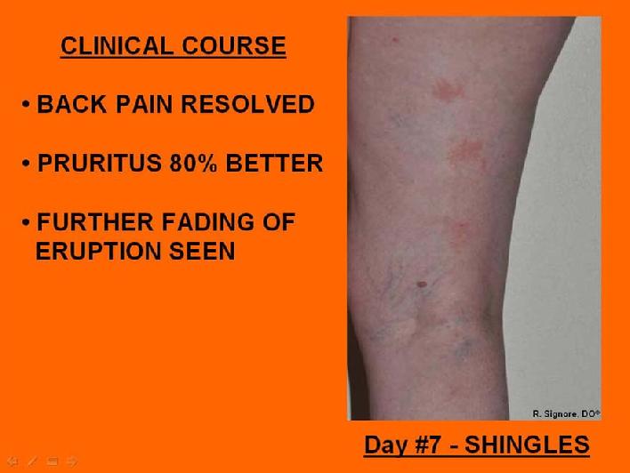 photo of successfully undergoing homeopathic medical treatment for herpes zoster (shingles) by Dr. Robert Signore.