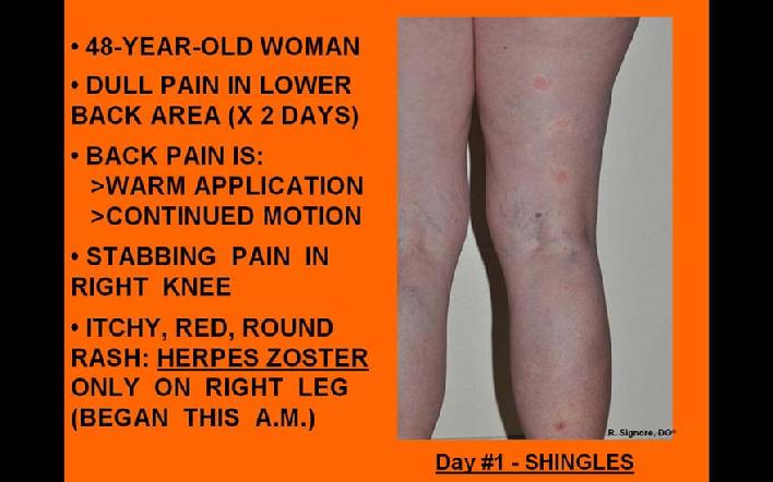 This 48 year old woman was seeh by Dr. Signore with a painful rash which appeared on her right posterior leg 12 hours previously.  One day prior to this, she experienced right lower back pain.  She was diagnosed with acute herpes zoster (shingles).  