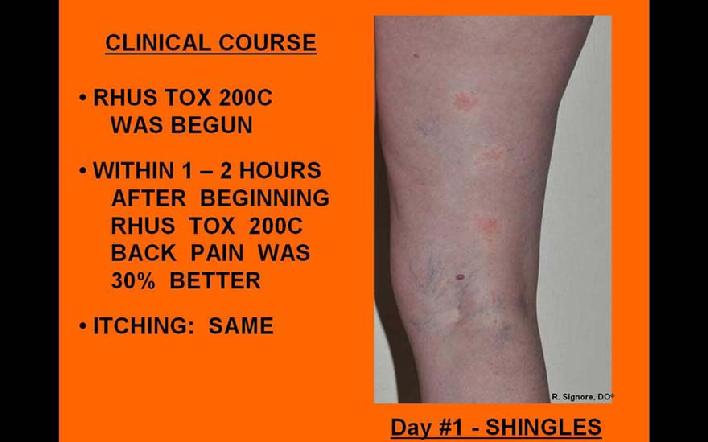 Phote of woman with acute herpes zoster (shingles).  She declined antiviral therapy and requested a natural treatment.  Homeopathic Rhus toxicodendron 200C was begun.  