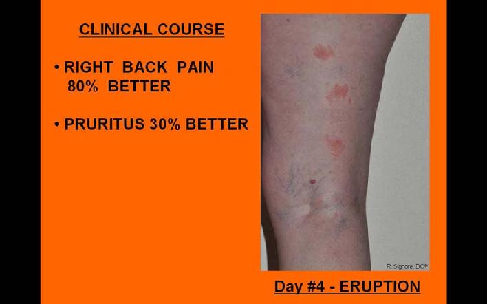 Photo of shingles treated with homeopathic rhus tox on day #4.  The patient's back pain is 80% better.  Her itching is 30% better with homeopathic treatment.  Note: no other pain medicines were taken.