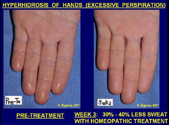 The above 2 photos show a healthy man treated at Dr Signore's Tinley Park Dermatology Office for excessive perspiration of the hands, feet, and underarms which he had for 14 years.  The next photo shows this man's hands and fingers which are 30% to 40% less sweaty after taking his individualized homeopathic remedy.  He then started a stronger strength of the same natural homeopathic remedy once per week.  After 7 weeks of homeopathic treatment, his excessive sweating is now approximately 75% better.  His palms are much less sweaty.  He can now walk barefoot at home.  He is pleased that he can now wear lighter colored shirts, now that his underarms sweat less.  