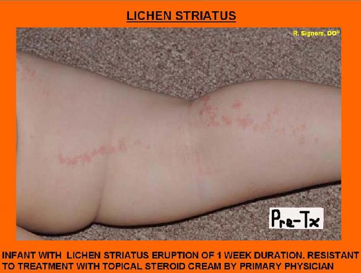 Pre-treatment photo of a healthy toddler with lichen striatus, which is a linear, suddenly-appearing eruption.