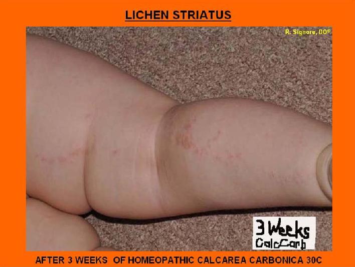 This photo of the same patient at 3 weeks after beginning homeopathic calcarea carbonica 30C twice daily by mouth shows that her lichen striatus eruption is now approximately 50% improved in terms of width and redness.  Her head now perspired less during sleep.  Additionally, she has softer stools and she no longer cried with bowel movements.  