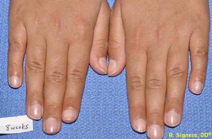 At 8 weeks of treatment, all warts on the fingers had resolved.  Her sadness, guilt, and anxiety had also resolved.  Her thirst had also normalized.  