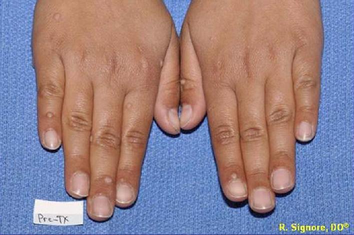 Warts are a common skin disorder amenable to the gentle action of homeopathic medicine.  The young patient shown here had 14 warts on the fingers.