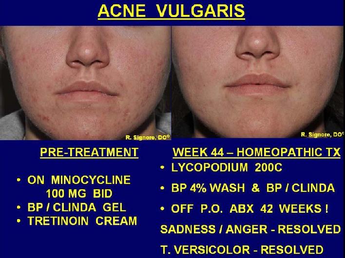 In the photo on the left, this young lady was taking minocycline, a strong prescription antibiotic, from another dermatologist.  Despite this, her face still was breaking out with acne pimples.  In the photo on the right, she is seen at week 44 of homeopathic treatment, along with benzoyl peroxide wash, and benzoyl peroxide /  clindamycin gel.  Her facial acne is approximately 95% improved.  Note, she has been off acne antibiotic pills for the last 42 weeks.