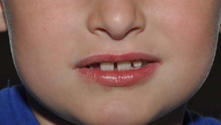 Photograph of young child, treated in Dr. Signore's dermatology office, seen 3 weeks after successful homeopathic treatment.  Note:  perioral dermatitis is completely resolved.