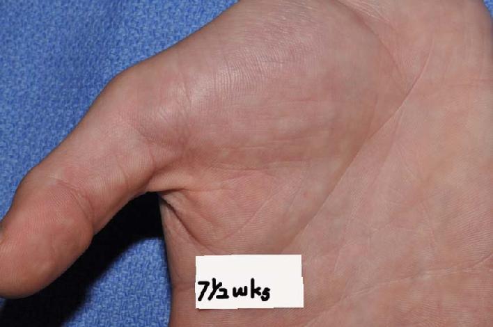 This photo from a patient seen at Dr. Signore's office, which shows palmar hyperhidrosis which now 70% improved with homeopathic constitutional treatment.  PHOTO COPYRIGHT, DR. SIGNORE, 2012