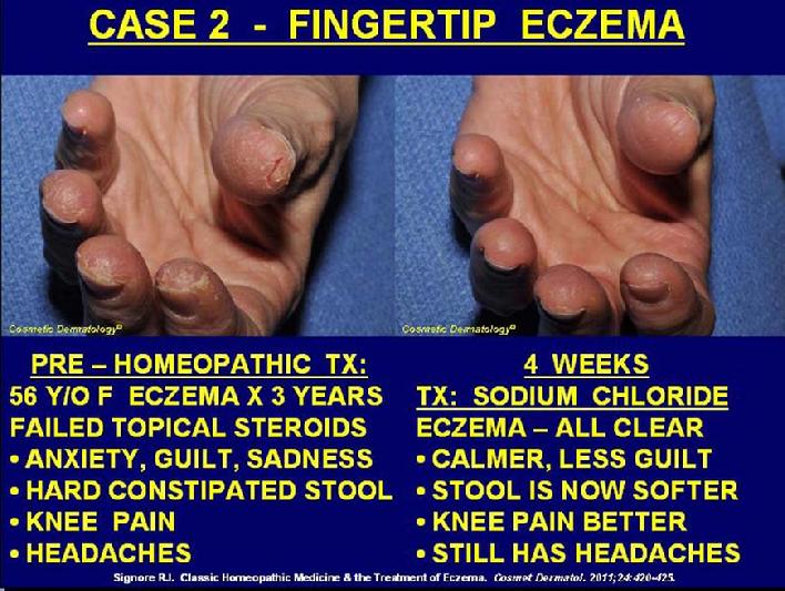 These are before and after photos of a patient treated with homeopathic medicine in Dr. Signore's office for irritant contact dermatitis of the fingertips.  This patient had previously failed potent prescription topical steroid application.  The after photo shows the fingertips have cleared completely.  Additionally, this patient experienced improvement in her knee pain, constipation, anxiety, and guilt.  