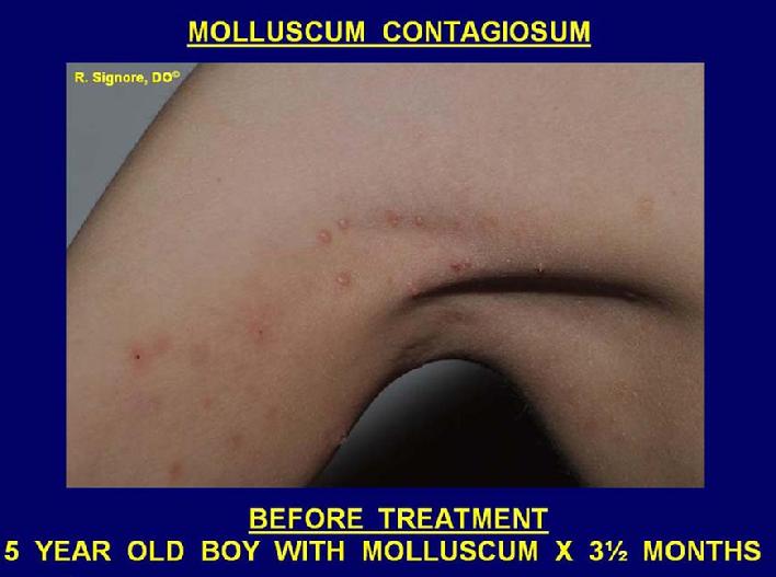 Photo of young child with molluscum contagiosum infection on the chest and arm before homeopathic medicine