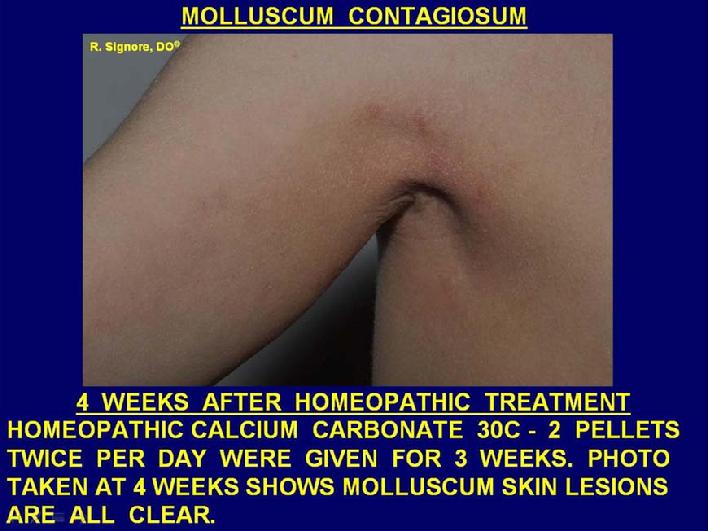 Photo of patient seen in Dr. Signore's dermatology office after successful treatment with homeopathic calcium carbonate twice daily for three weeks.  Note: all molluscum contagiosum lesions have gently resolved and are all clear at four weeks.
